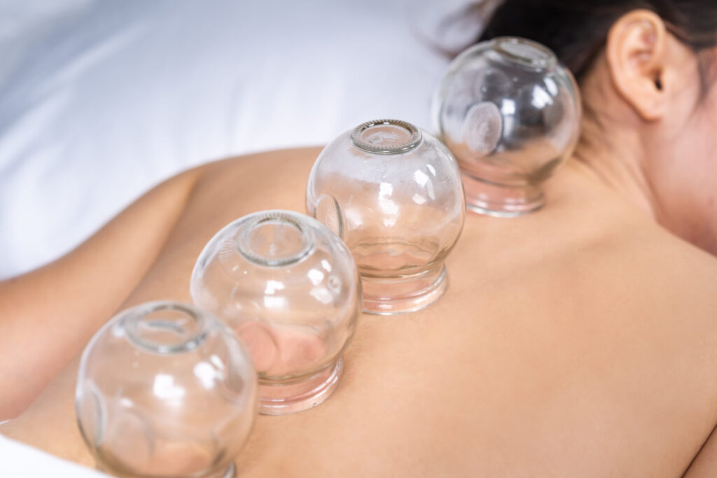 Woman having cupping treatment on back